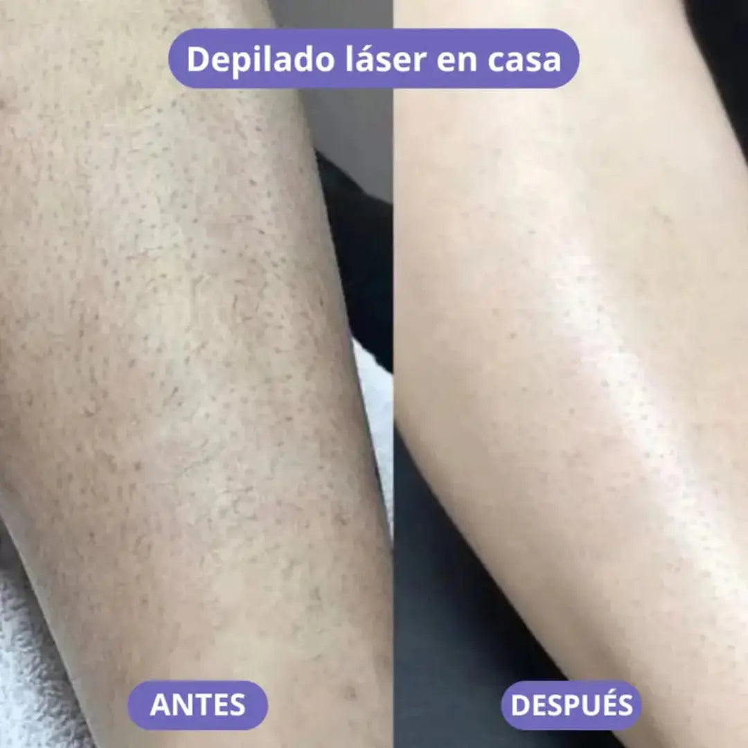 Depilación sin dolor e irritación: Depiladora Láser